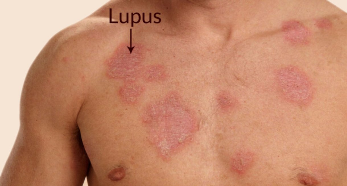 Lupus (Kelebek Hastalığı) Nedir?